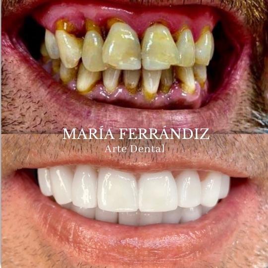 Antes y Después de un tratamiento periodontal en nuestra clínica María Ferrándiz