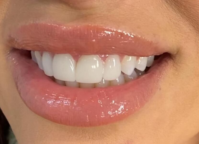 Estética dental en María Ferrándiz - Carillas de porcelana