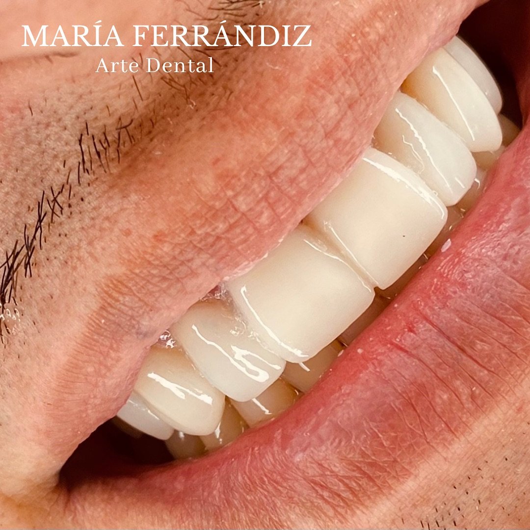 Carilla de porcelana en nuestra clínica María Ferrándiz