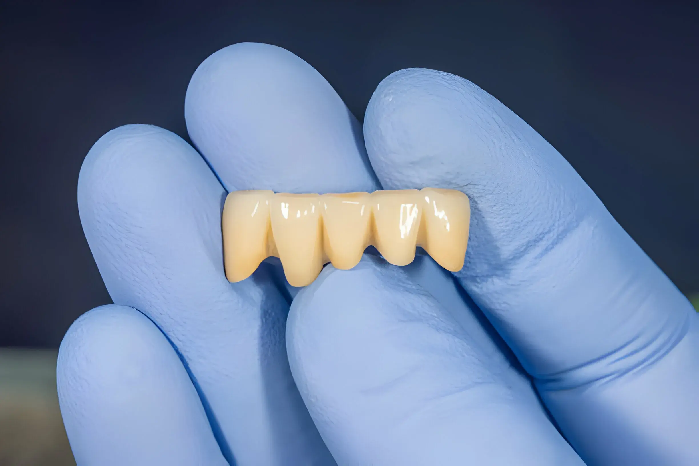 Coronas de zirconio para una sonrisa natural y radiante