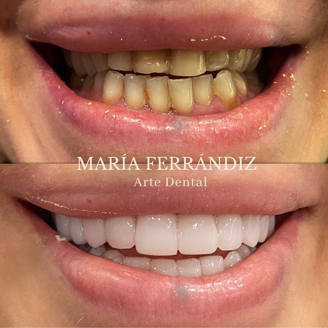 Soluciones de restauración dental con zirconio