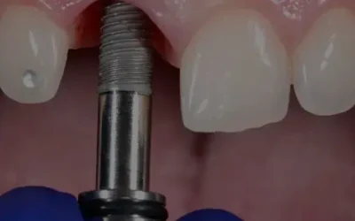 ¿Qué son los Implantes Dentales?