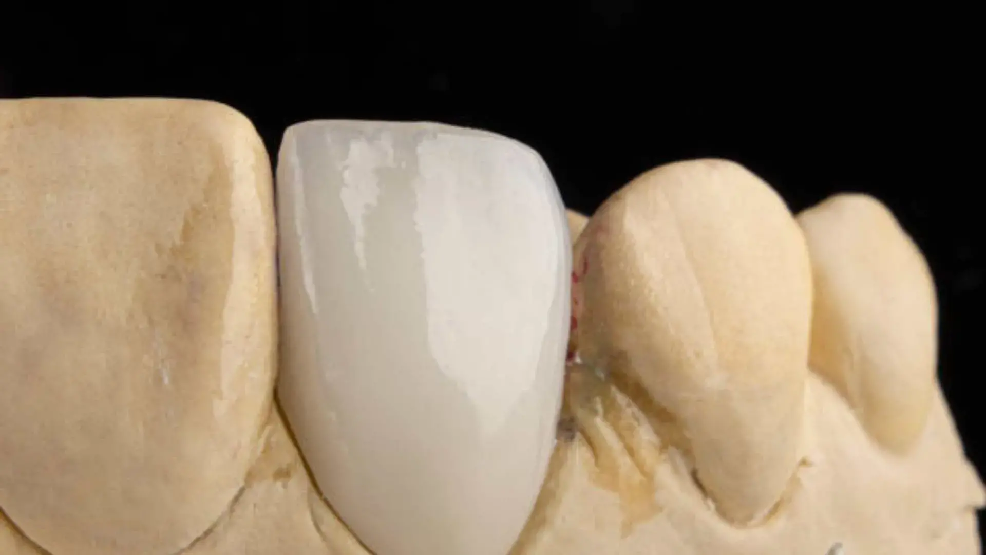 Carillas de porcelana carilla de porcelana vs composite