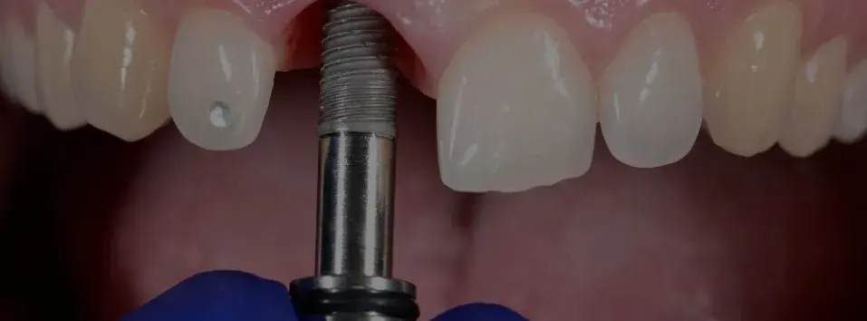 Implantes dentales