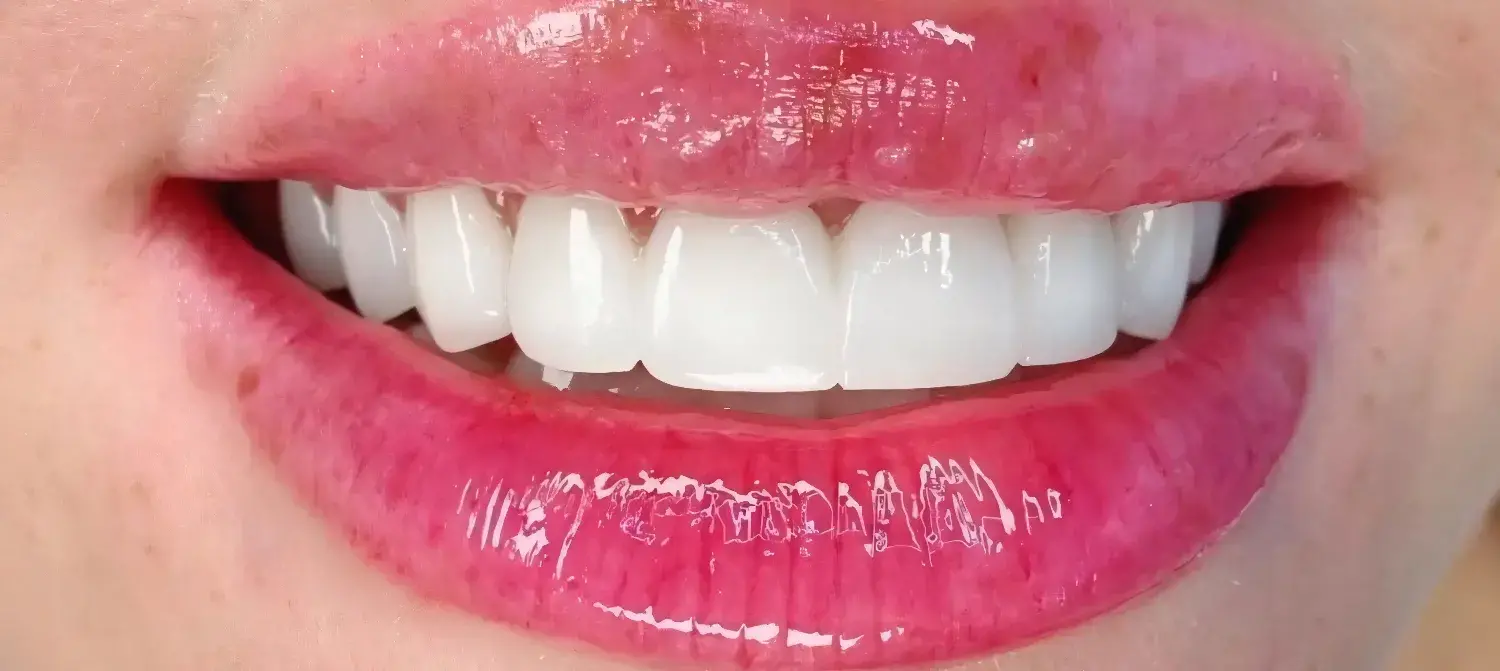 Tratamiento de carillas de porcelana en la clínica María Ferrándiz diferencias entre carillas de porcelana y composite