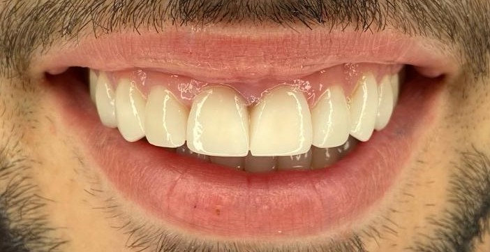 Endodoncia y oscurecimiento dental: causas y soluciones estéticas