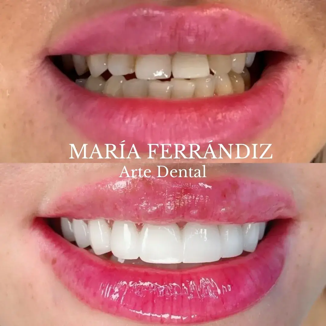 Diferencia entre carillas y diseño de sonrisa: ¿son lo mismo?