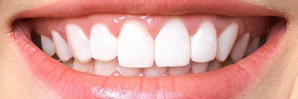 teeth-01